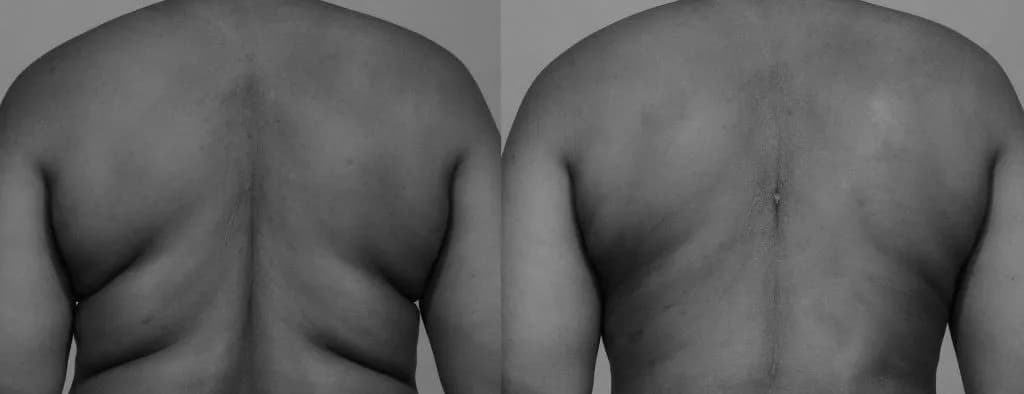 Body Contouring — Case 1 — Before and After