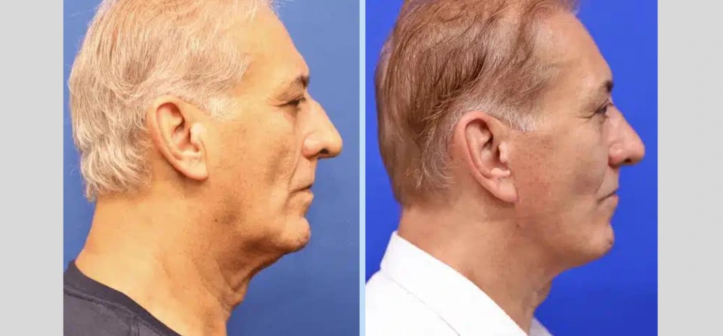 Body Contouring — Case 2 — Before and After