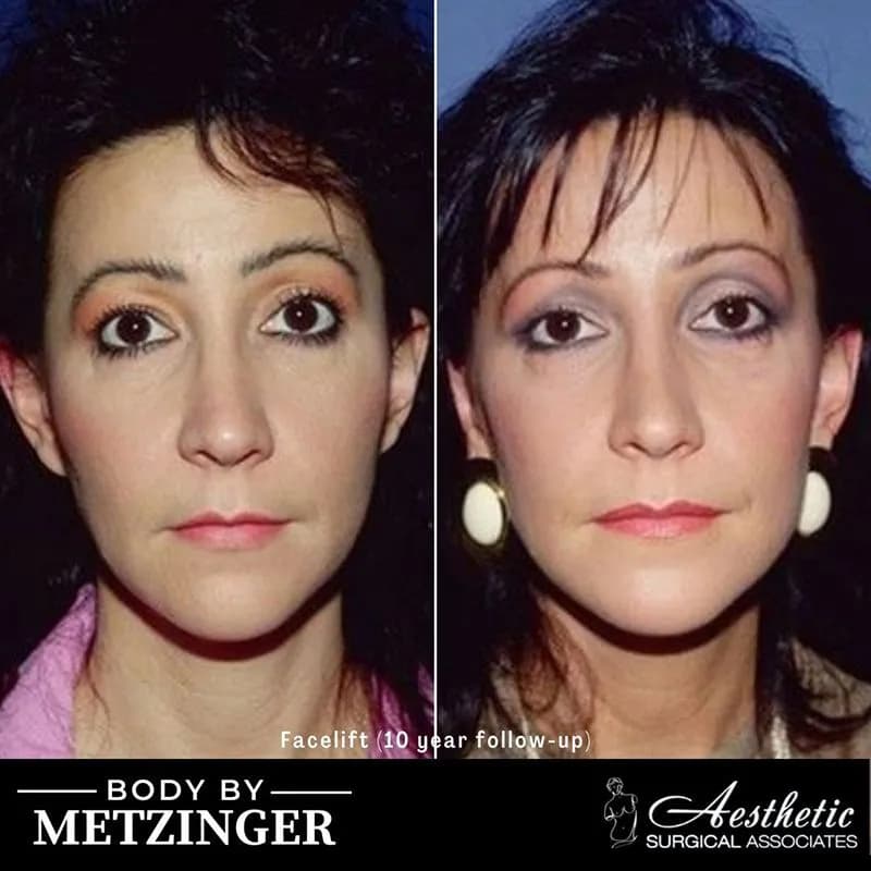 Skin Rejuvenation — Before and After