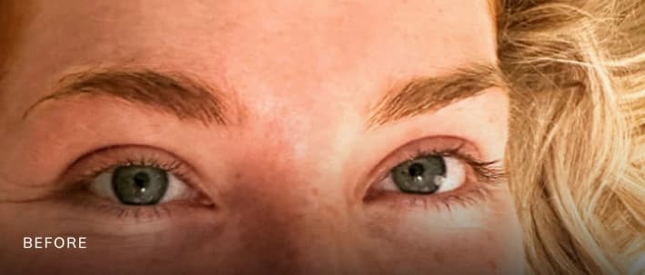 Facial Transformation — Case 1 — Before and After