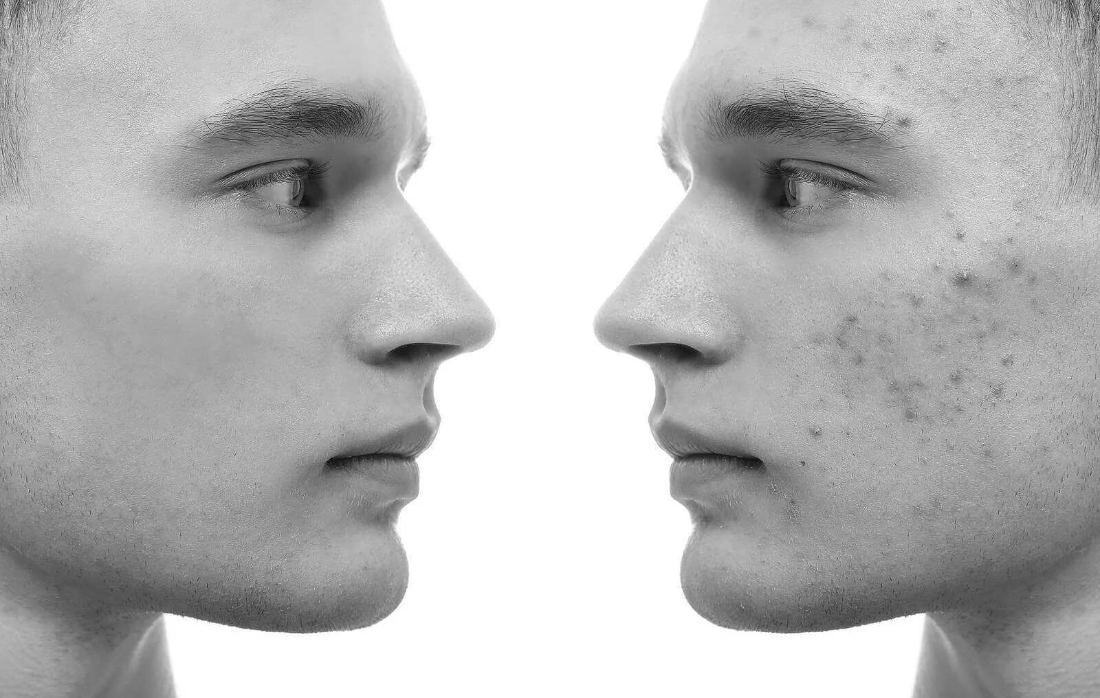 Men's Skin Clearing — Before and After