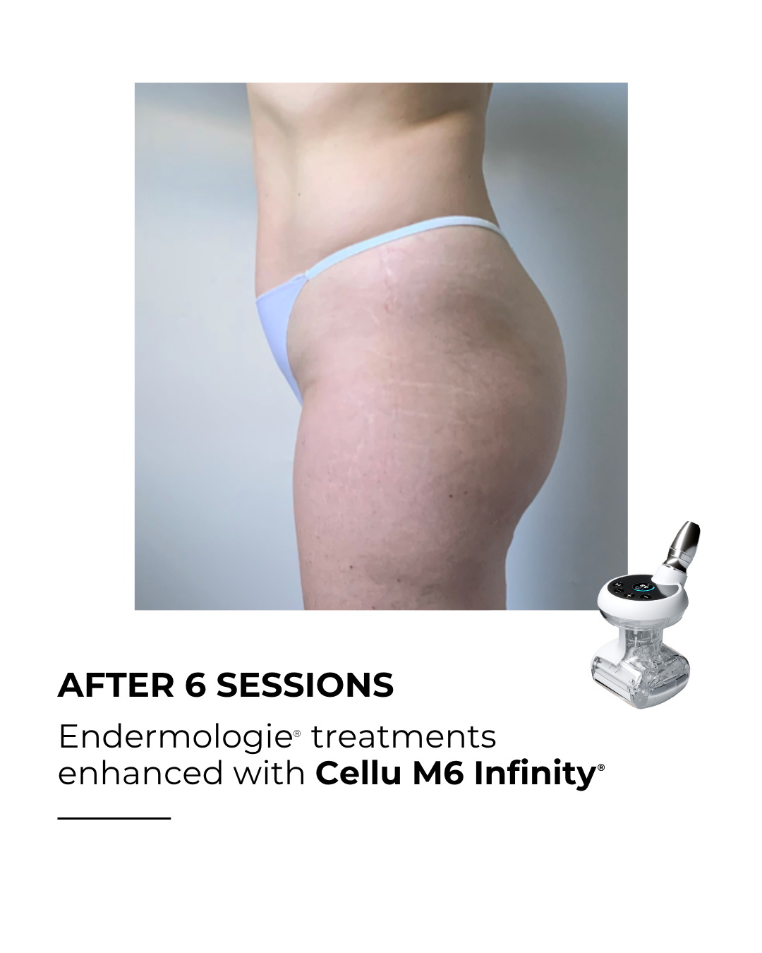 After 6 LPG sessions smoother contours Aliso Viejo