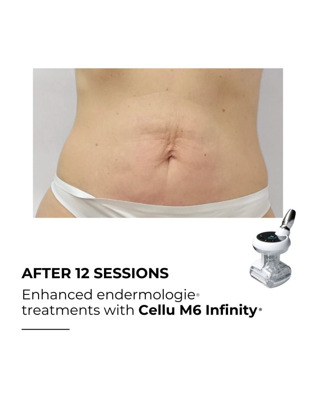 After 12 LPG sessions firmer skin Laguna Beach