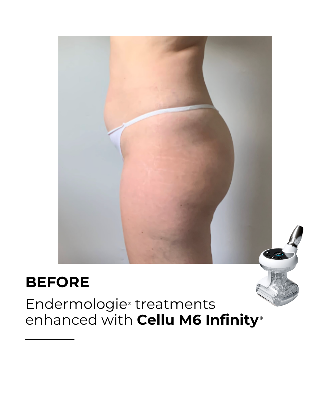 Before LPG treatment cellulite reduction Orange County