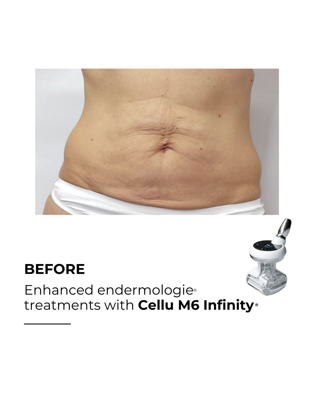 Before LPG treatment skin tightening Newport Beach